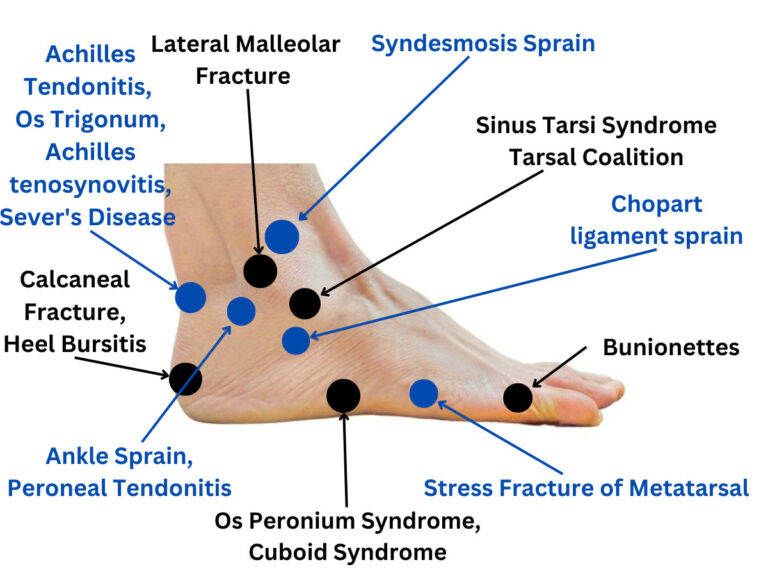 The Ultimate Foot Pain Chart: Everything You Need to Know - MediCure Wise