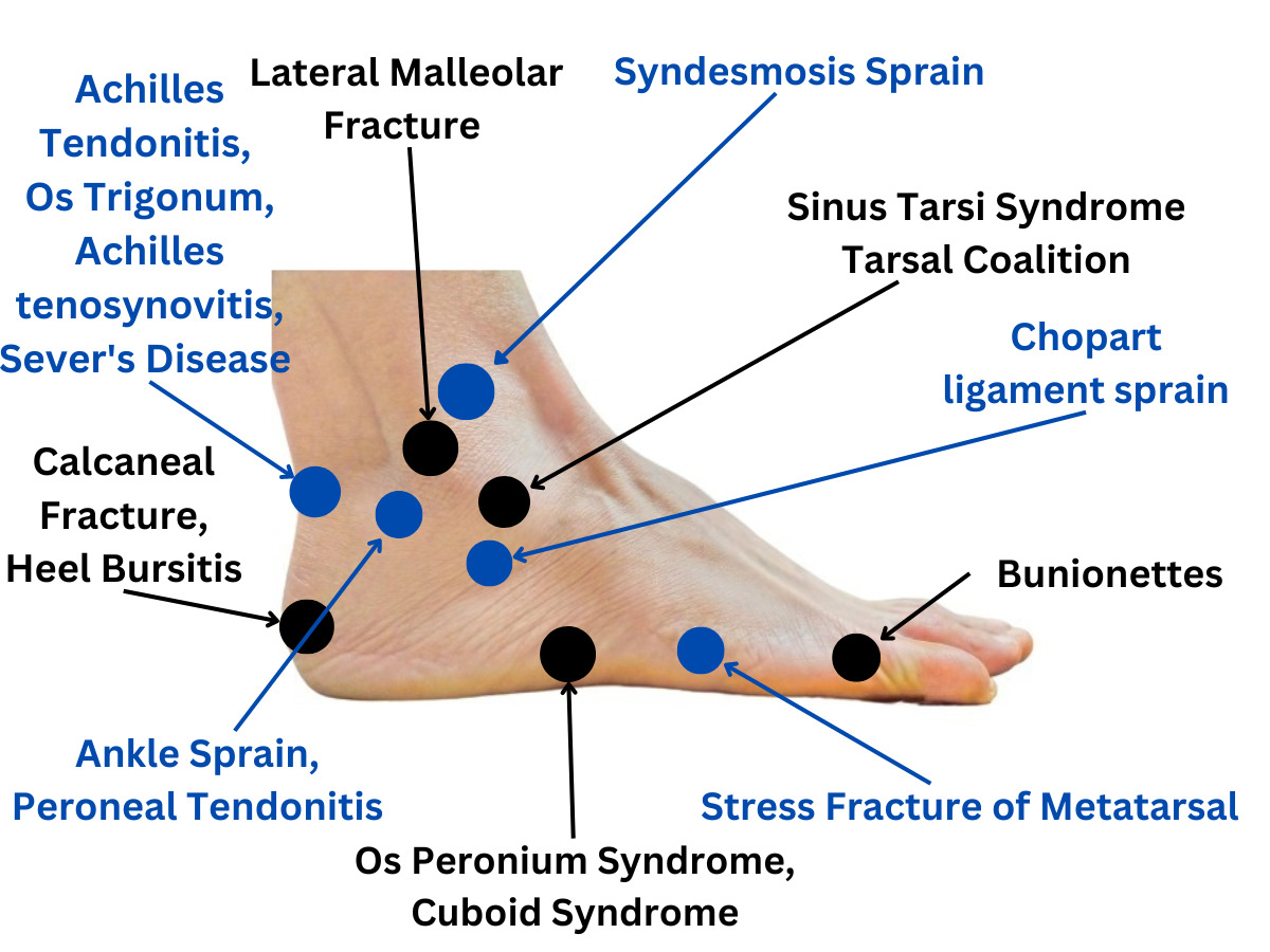 Syndesmosis Sprain 2 