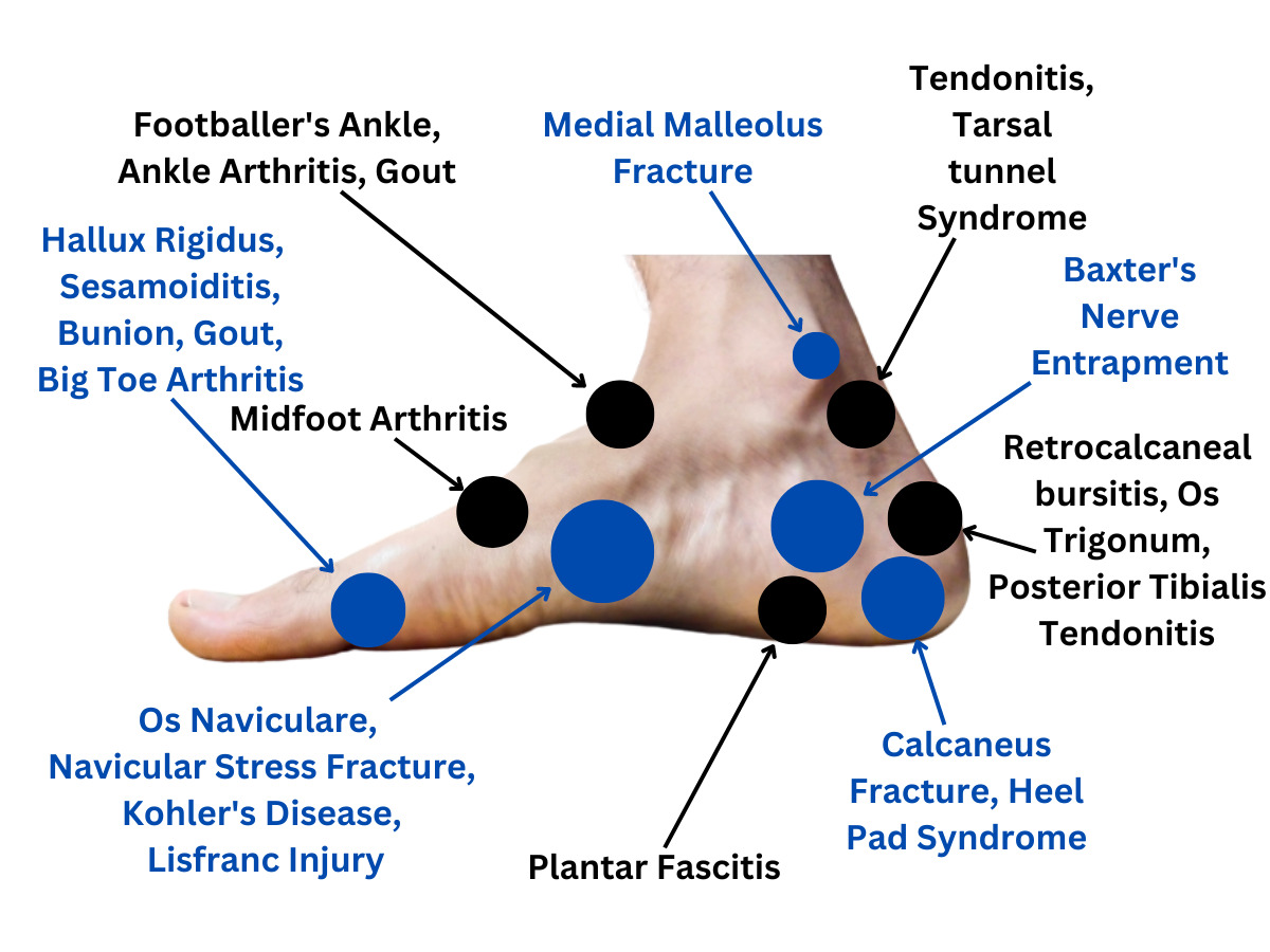 The Ultimate Foot Pain Chart: Everything You Need to Know - MediCure Wise