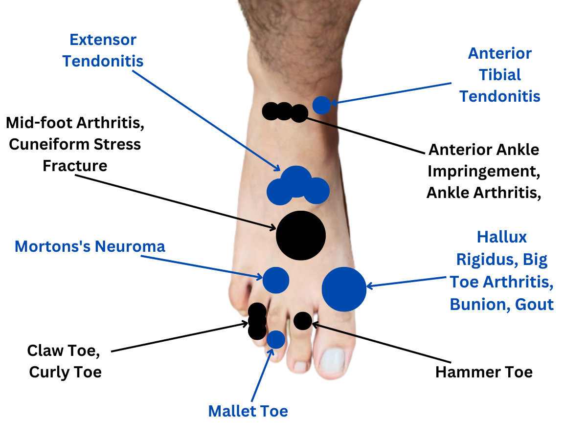 The Ultimate Foot Pain Chart: Everything You Need to Know - MediCure Wise