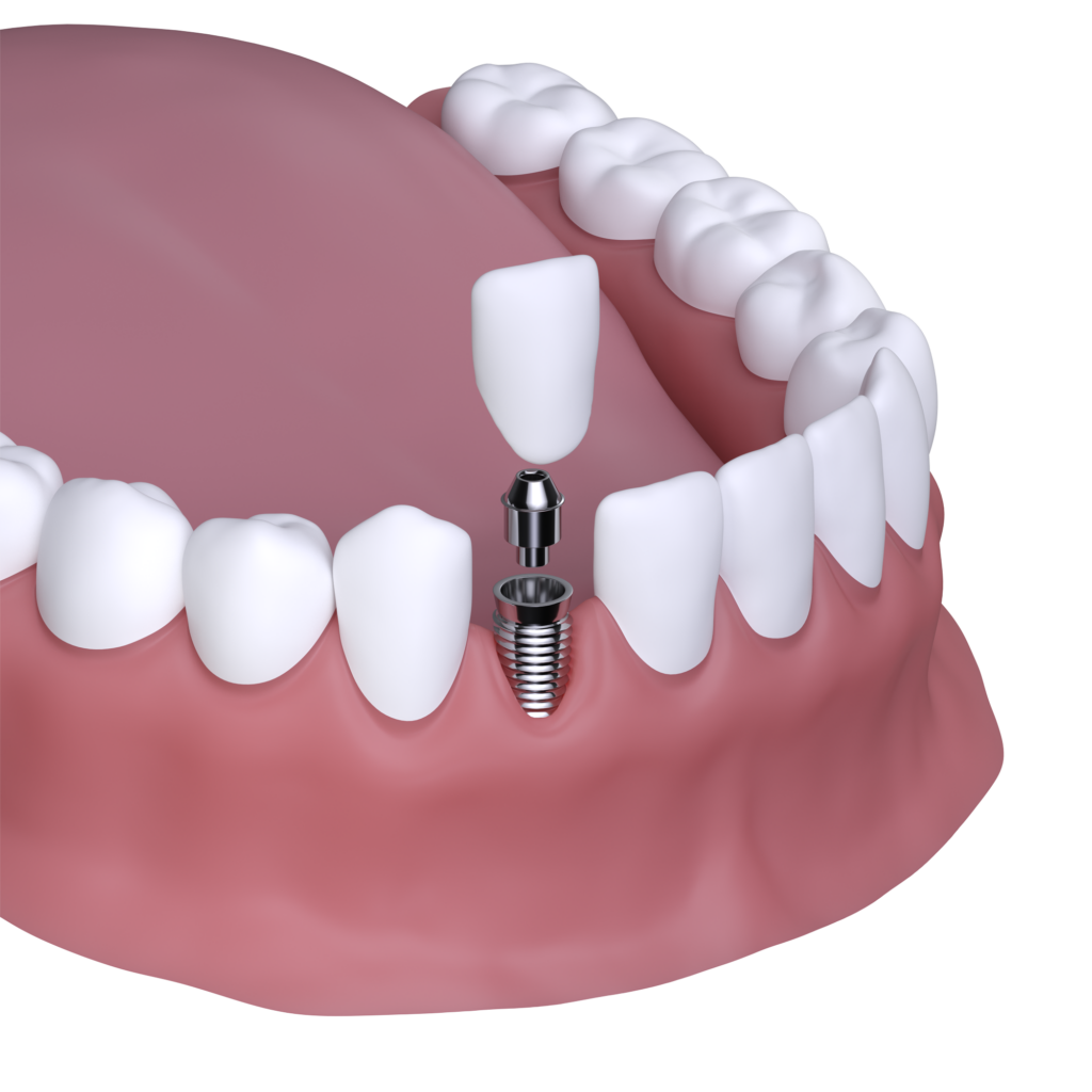 Después de un Implante Dental se Puede Trabajar