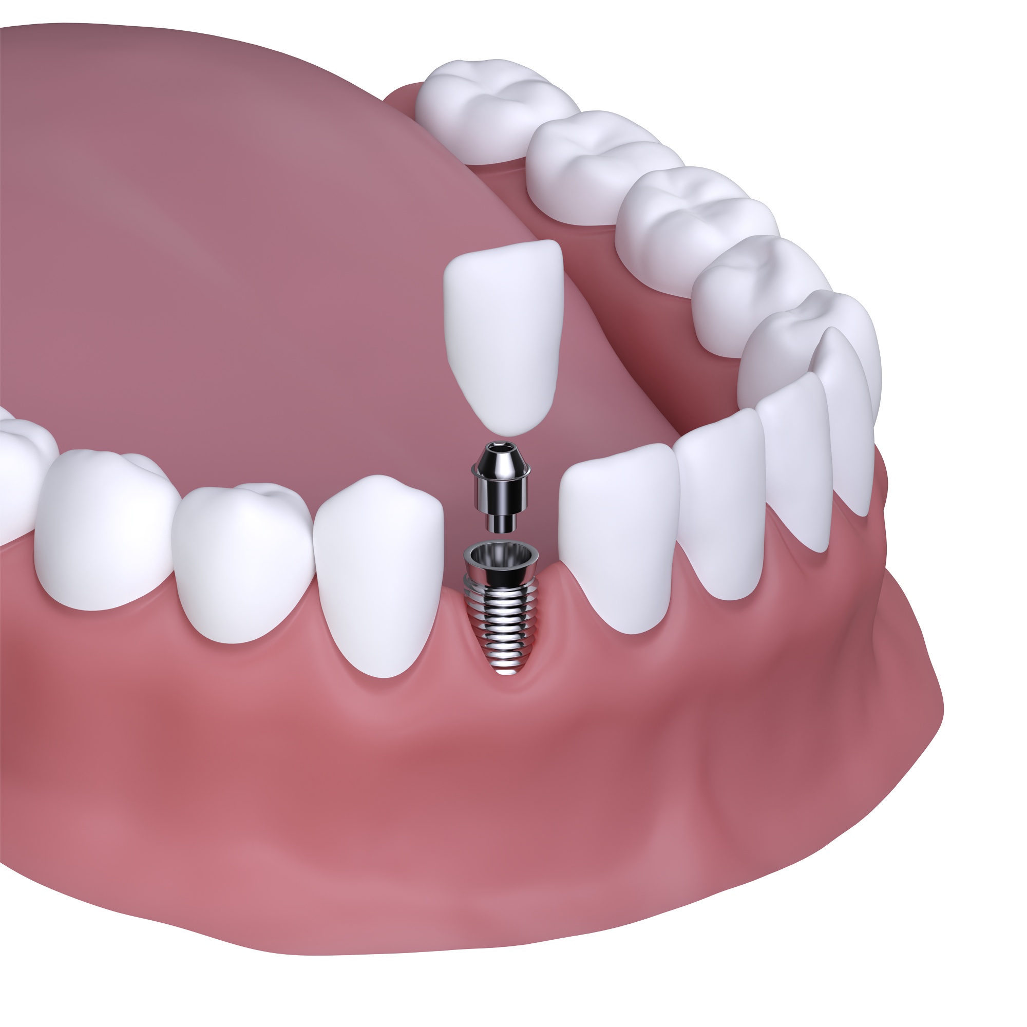 Después de un Implante Dental se Puede Trabajar